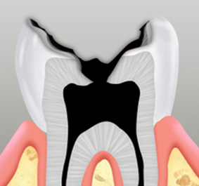 충치진행4단계